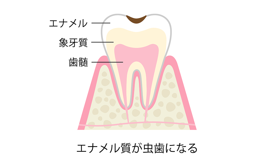 削る必要がある場合の状態